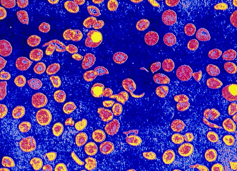 Coloured light micrograph of a blood smear showing distorted red blood cells in sickle cell anaemia.